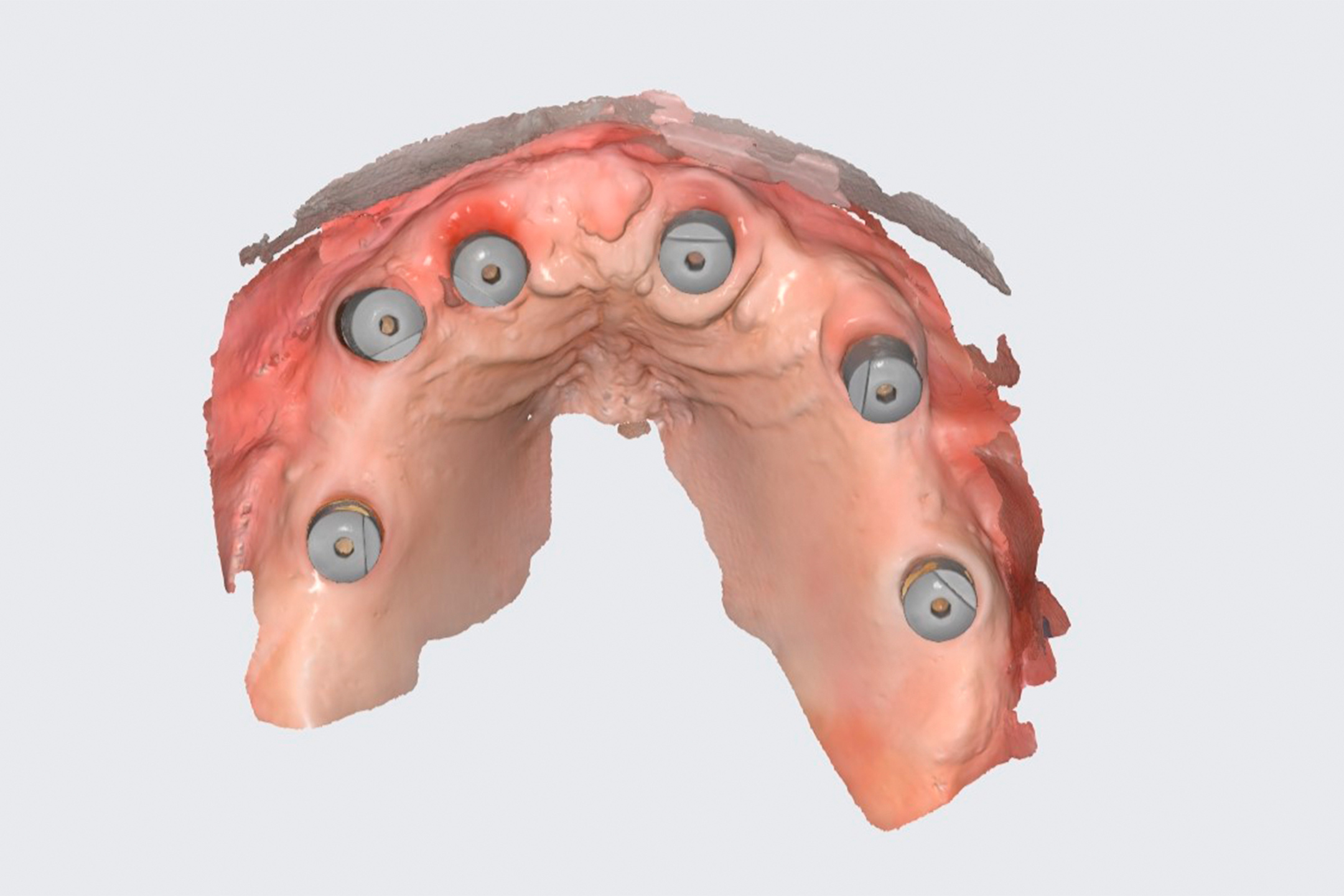 Зуб на верхней челюсти был разрушен и удален около 4 лет назад, за это время нижний зуб, напротив утраченного, начал выдвигаться вверх