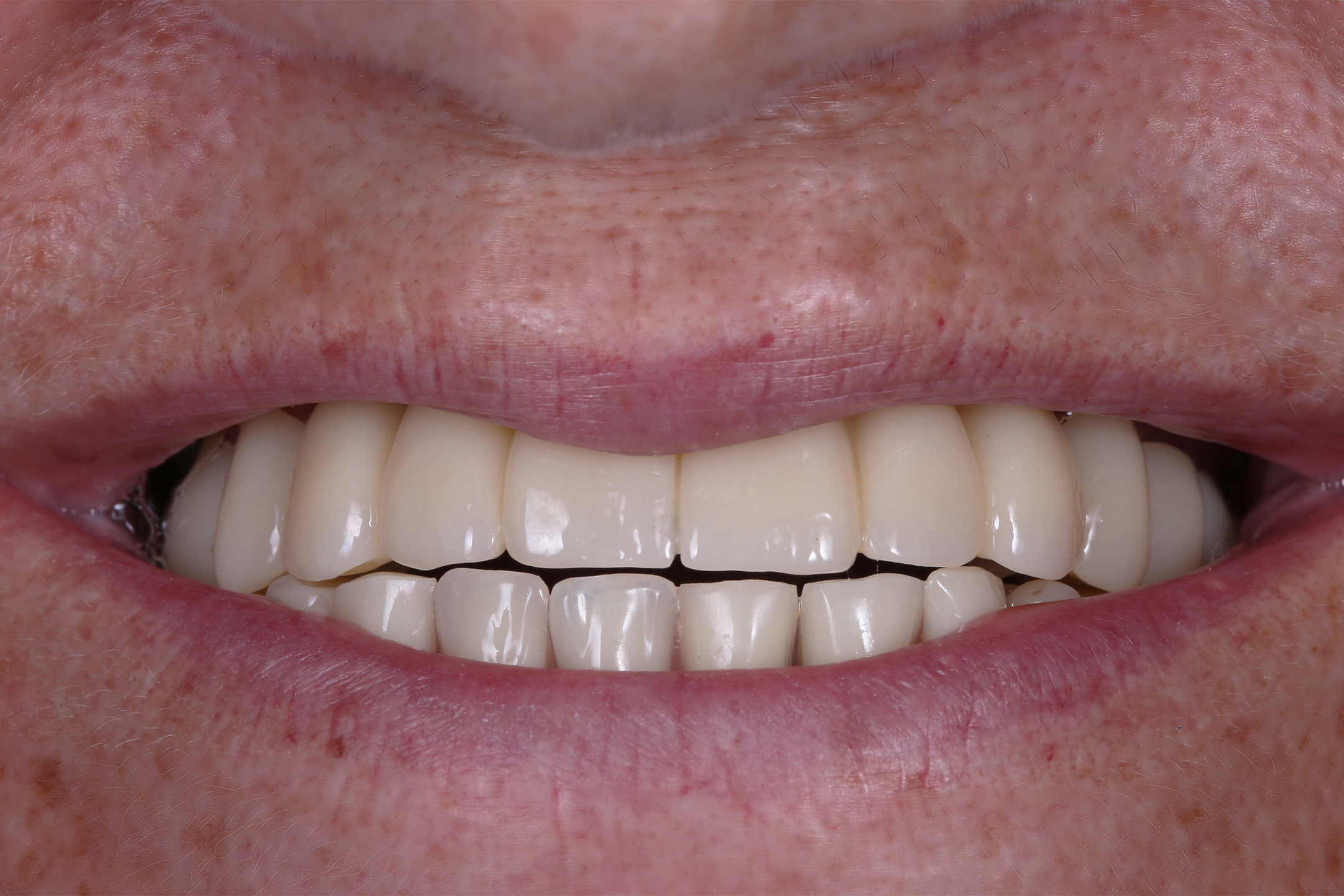 Проведена имплантация, а затем через 3 месяца установлена постоянная циркониевая коронка.