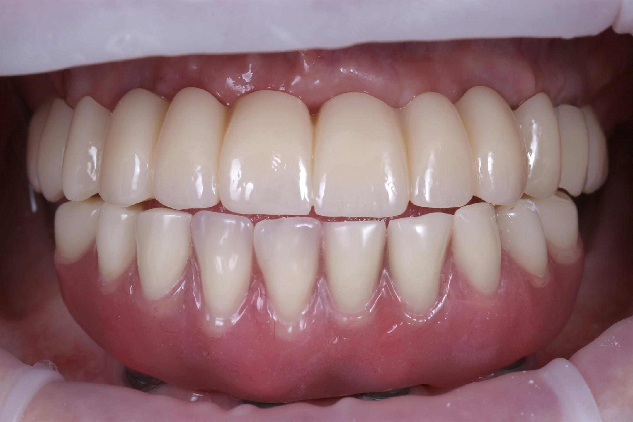 Результат работы по установке имплантов all an 4.