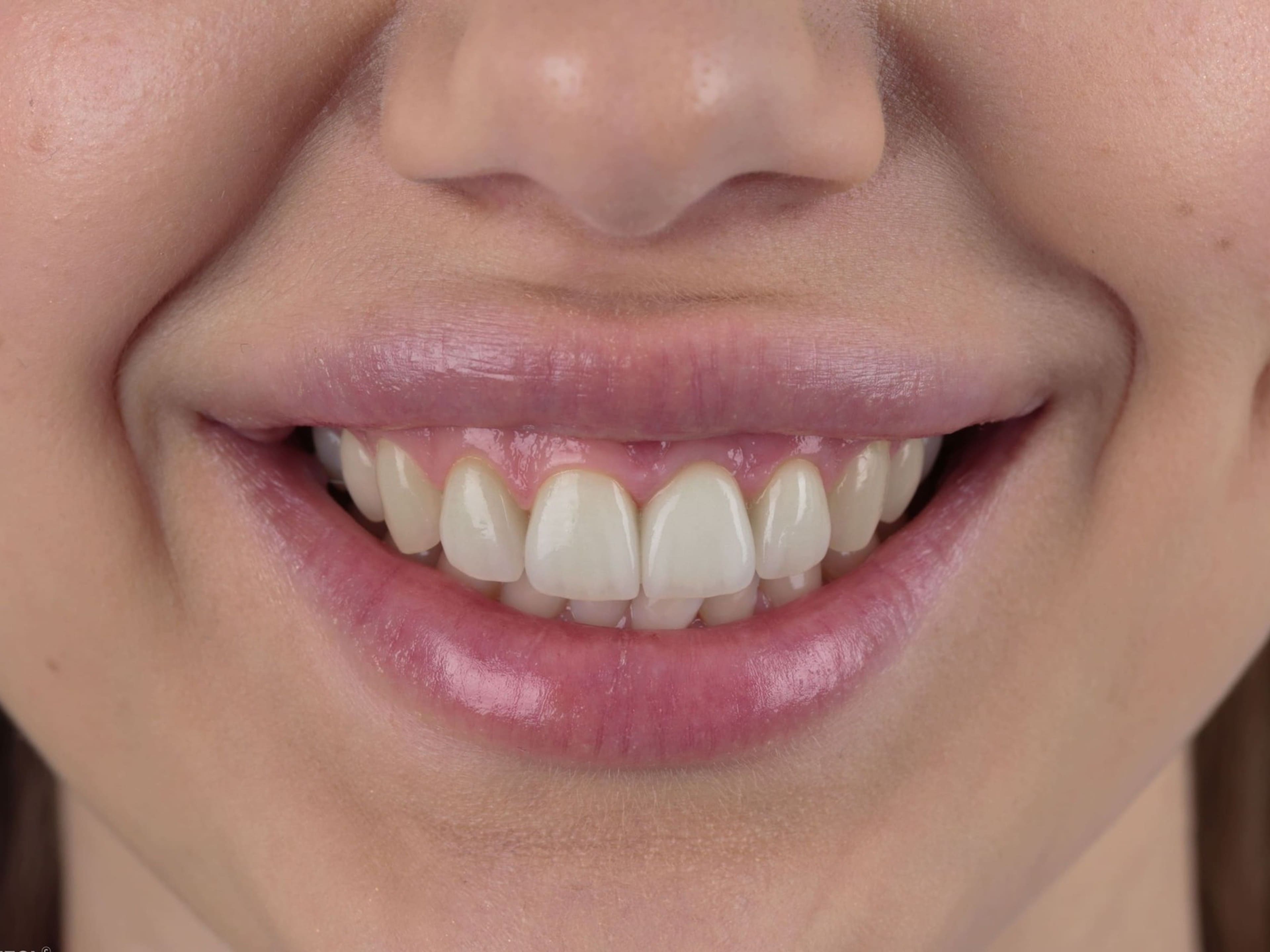 Имплантация зубов является самым современным способом вернуть потерянные зубы