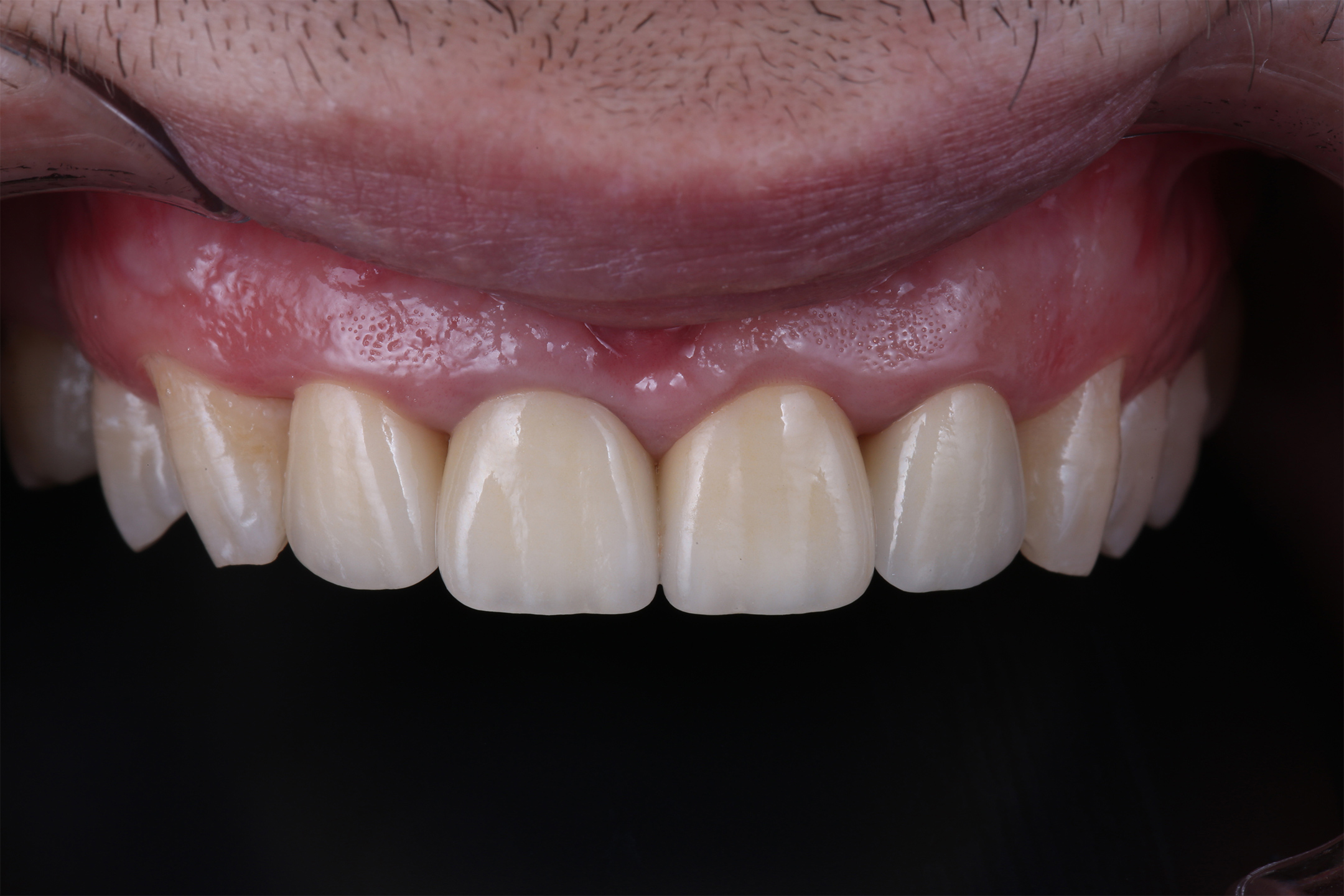 Новые керамические реставрации идеально вписаны в зубной ряд.