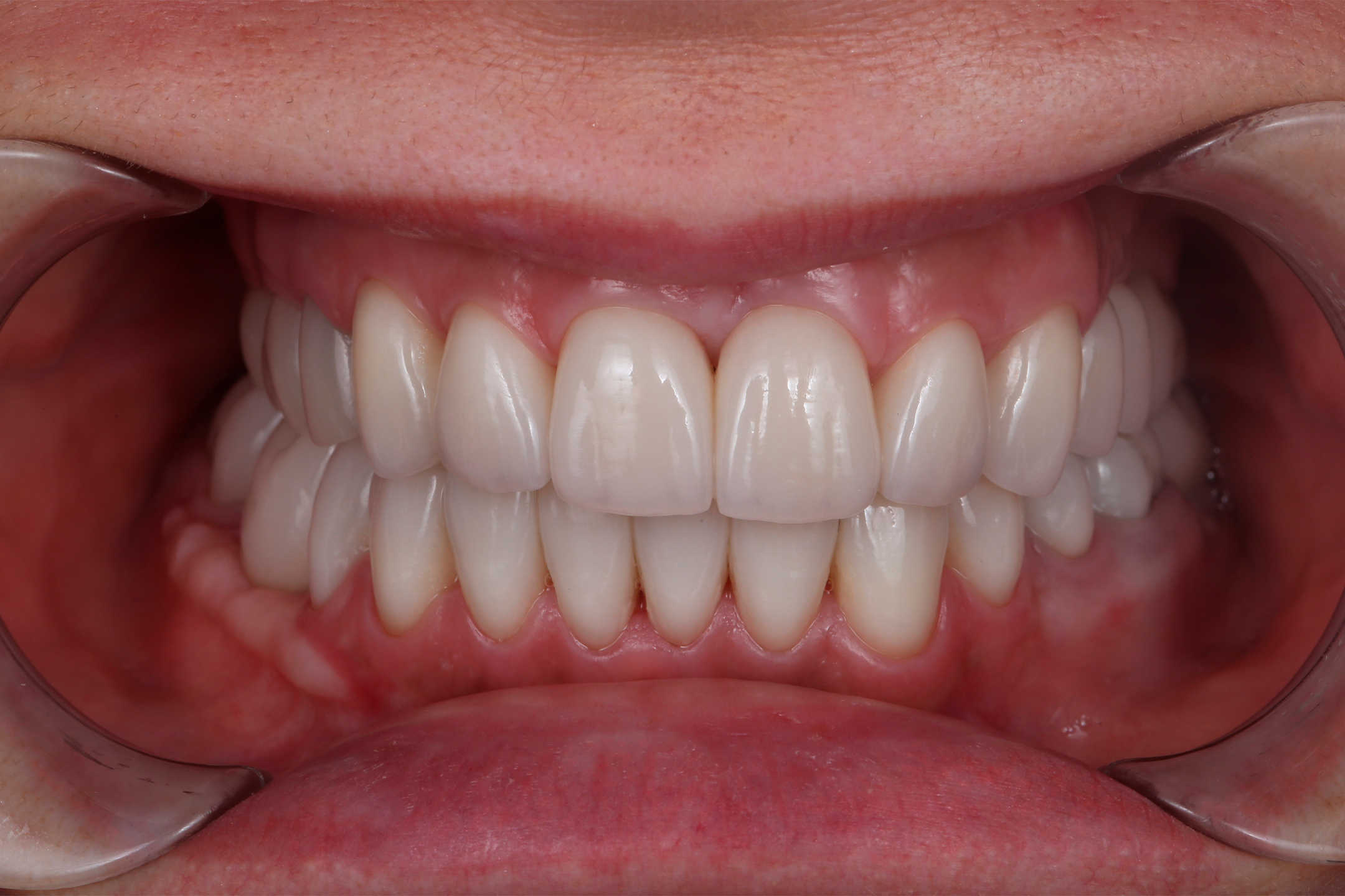 Установка имплантов и временных коронок.