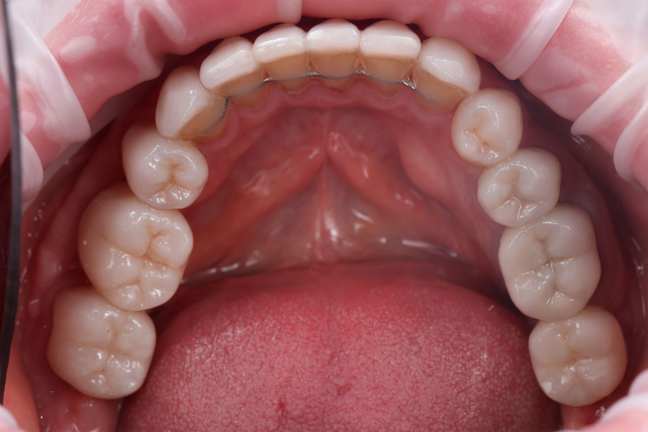 Результат работы - новая улыбка.