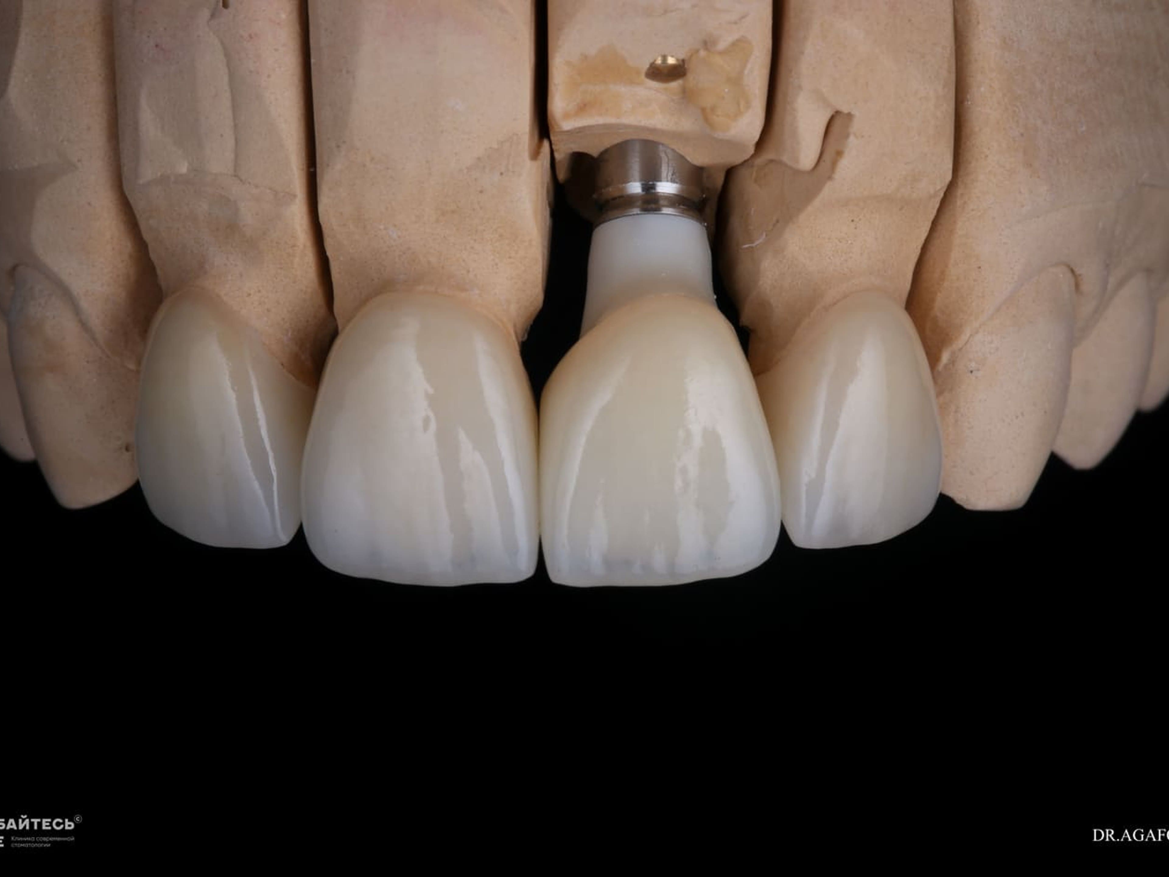 Компьютерная модель десны с установленным имплантом.