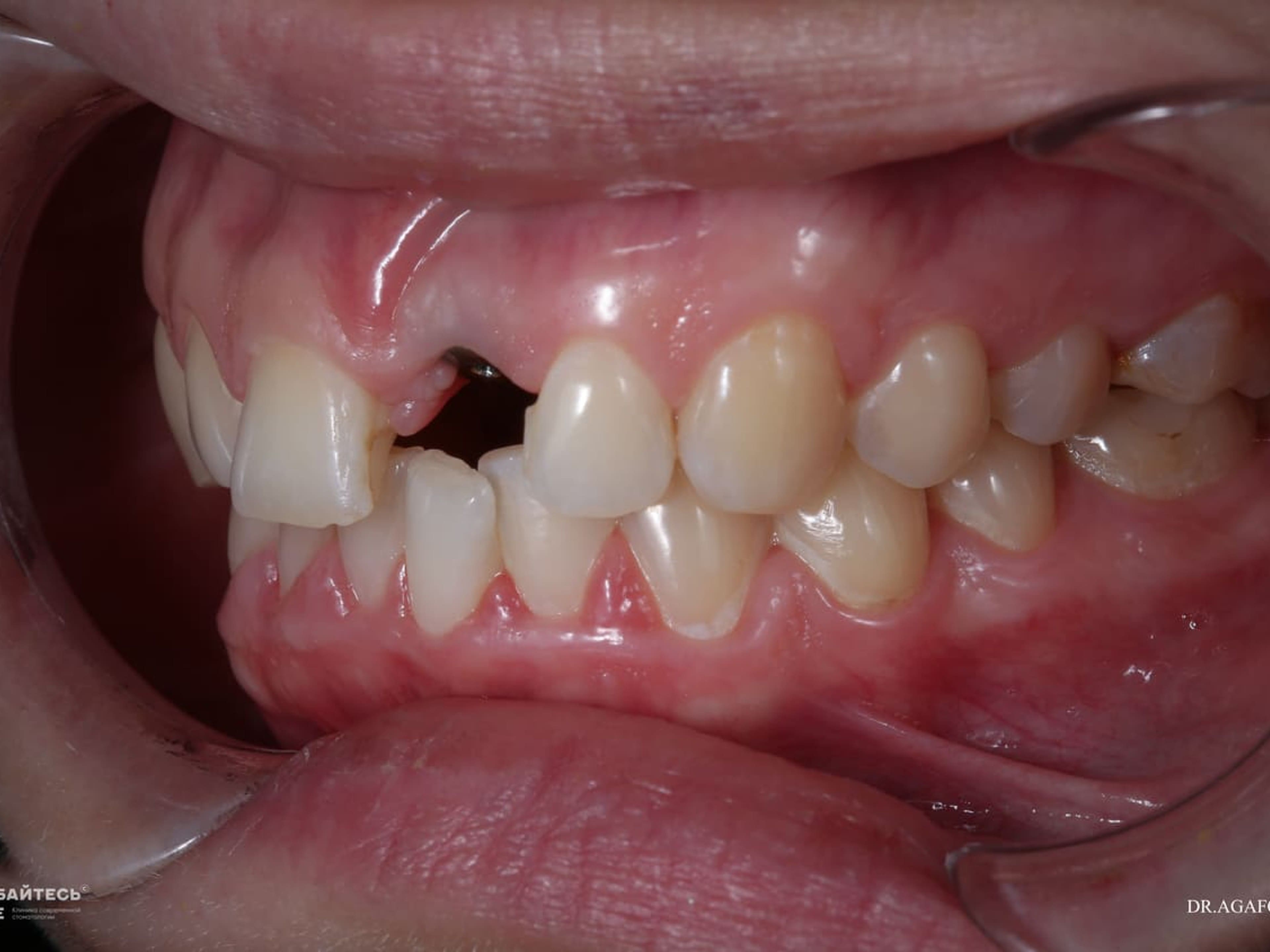 Под местной анестезией проводится небольшой разрез в десне и формируется отверстие в костной ткани челюсти.