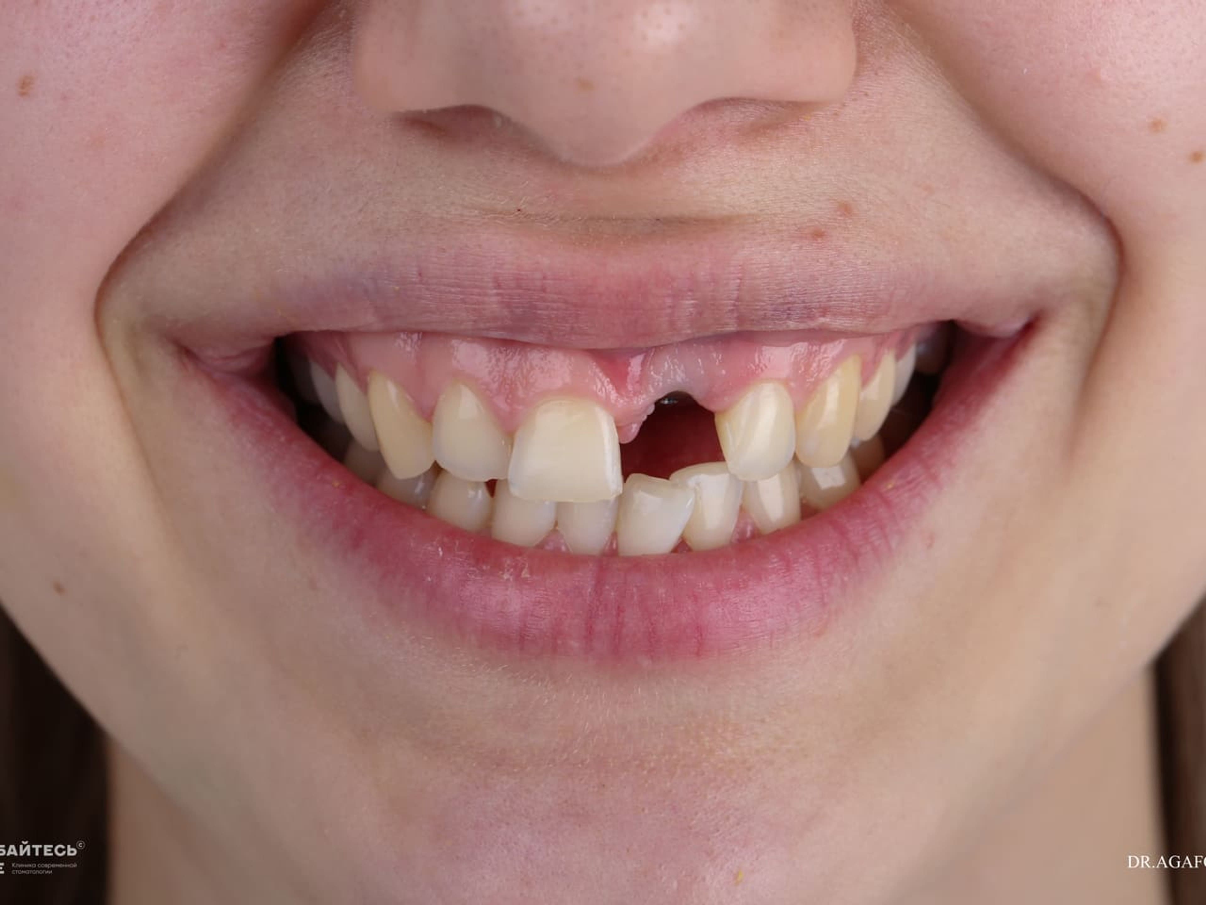 Процесс установки зубных имплантов, стадия 3