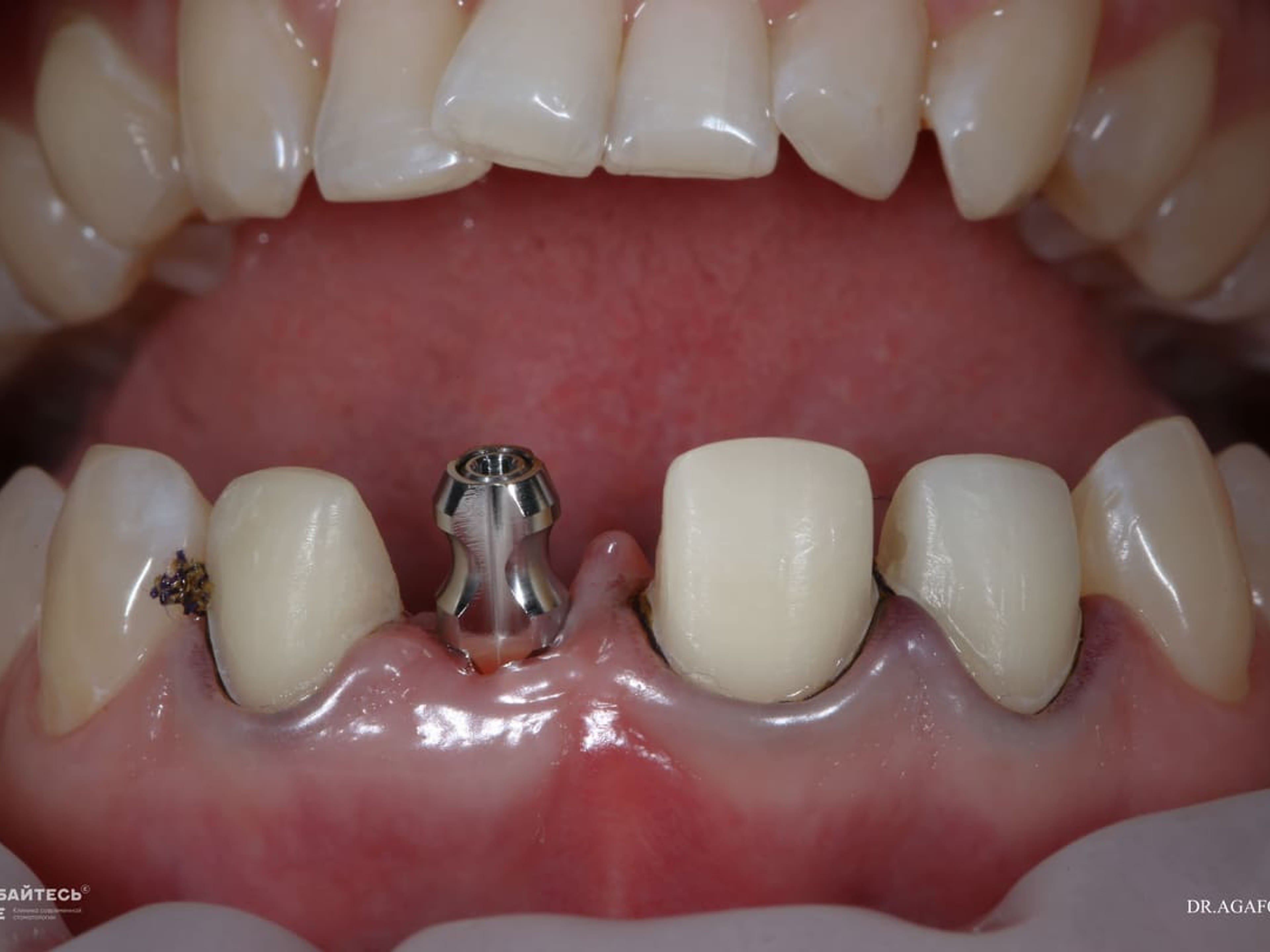 В отверстие вставляется имплантат, который замещает корень отсутствующего зуба. Имплантат накрывается специальным колпачком.