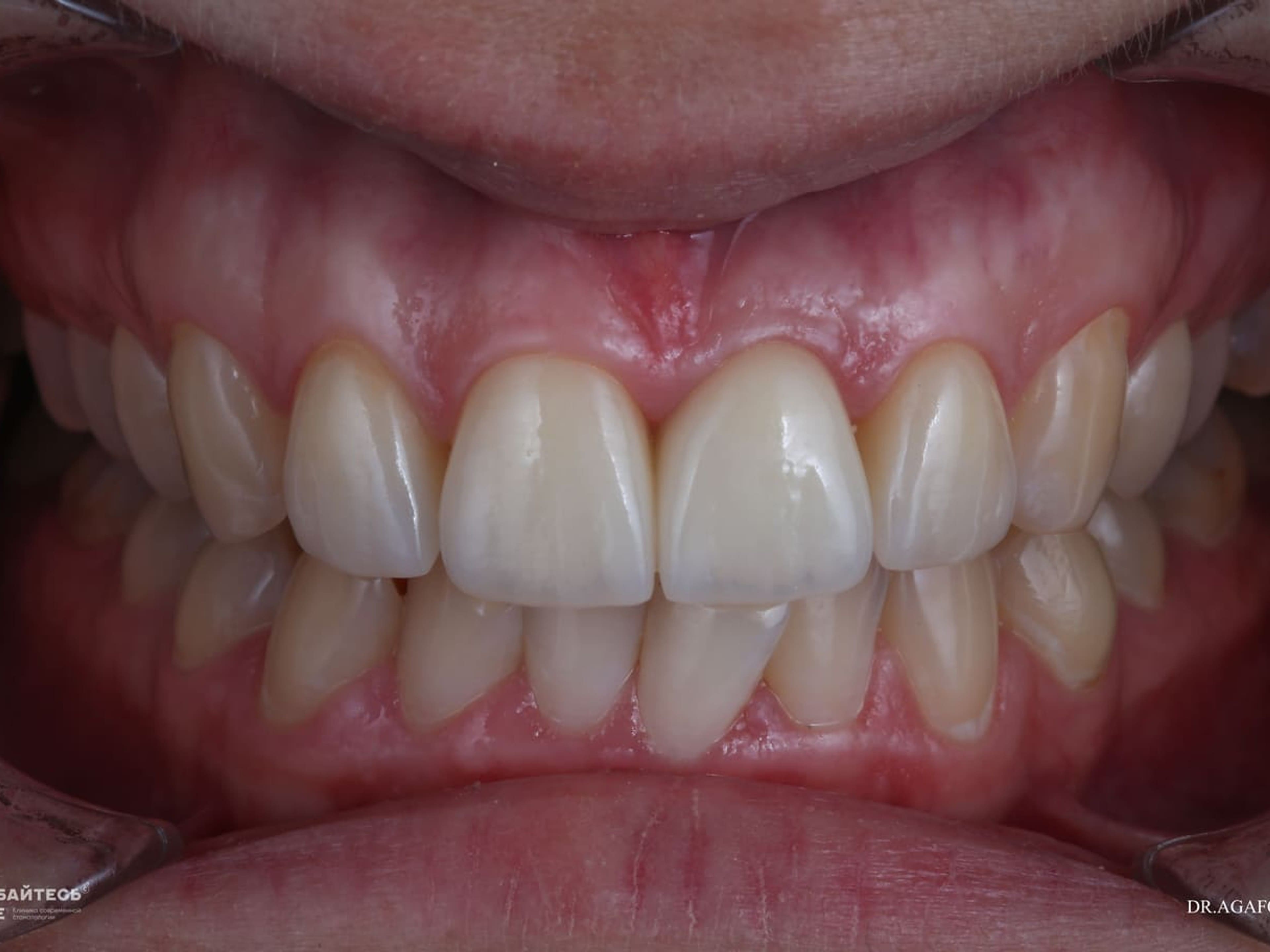 На абатмент устанавливается коронка в качестве видимой части зуба, которая обеспечивает его функцию и эстетику.