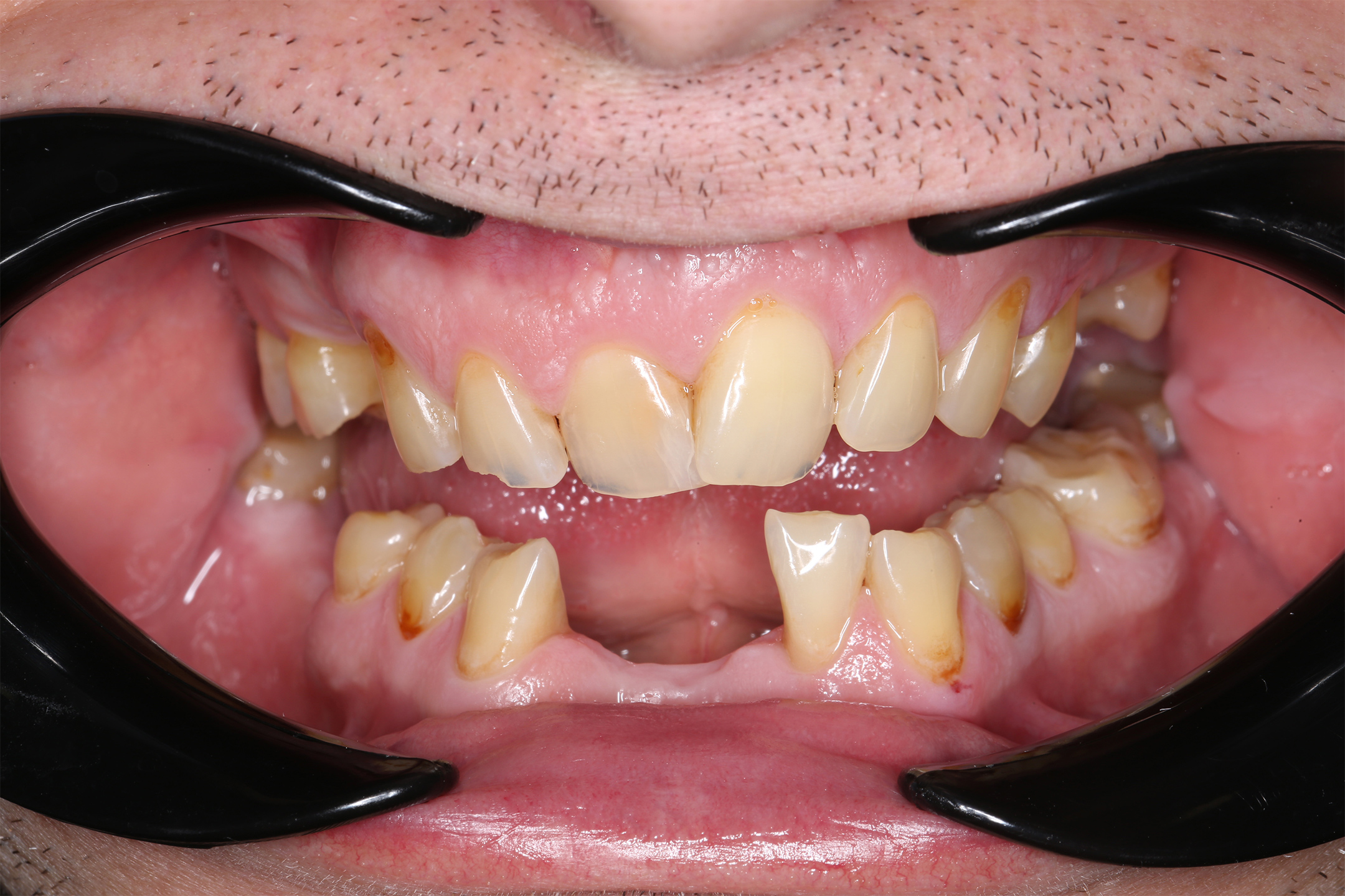 У молодого пациента нарушена эстетика зубов - отсутствие возможности улыбаться, утрата жевательной функции и запах изо рта.