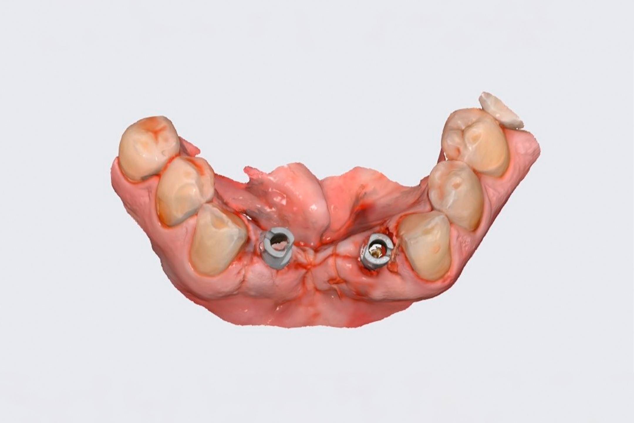 После моделировки новой улыбки изготовлен навигационный шаблон, по которому в предельно точных положениях установлены импланты.