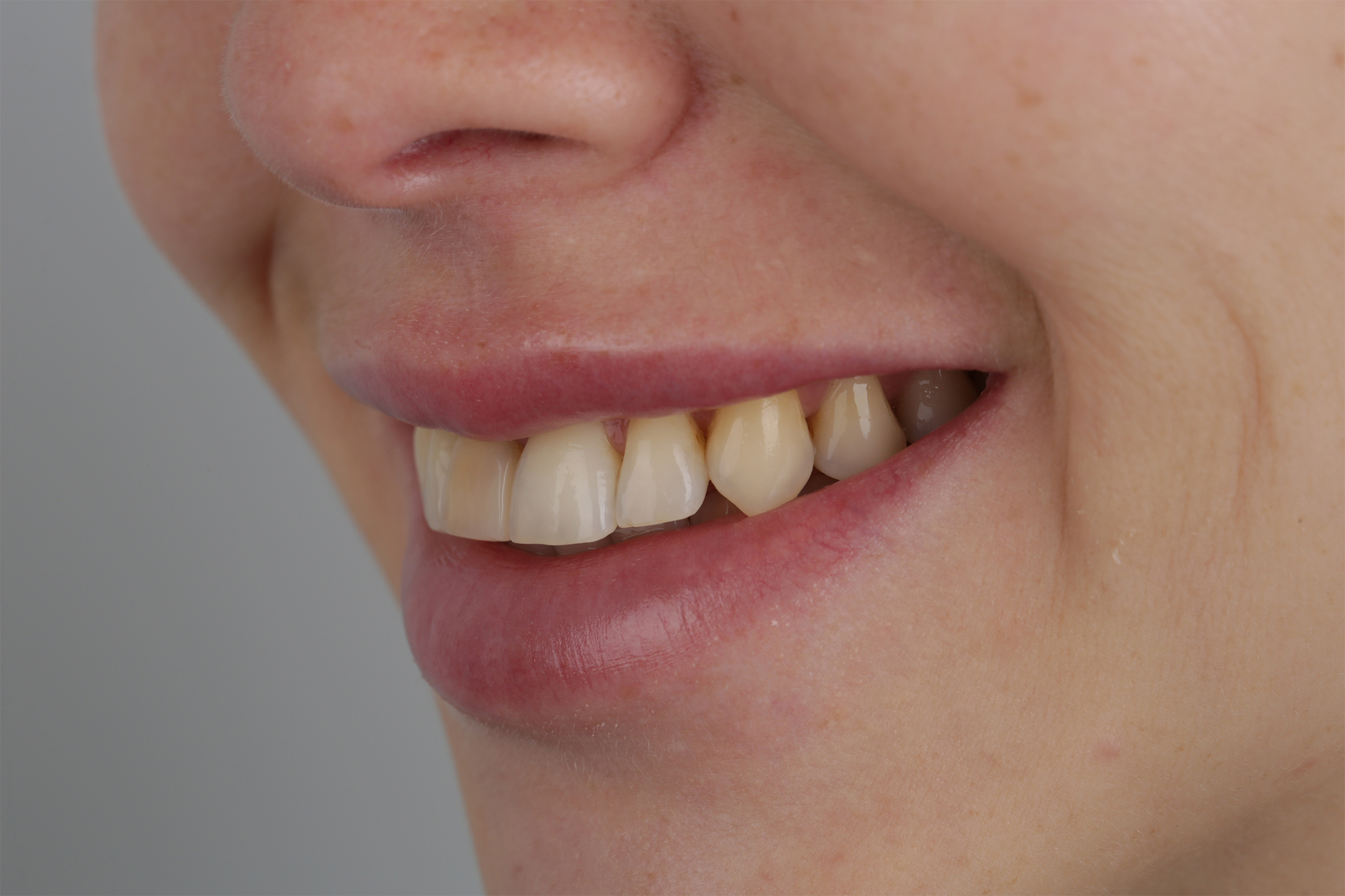 Затруднение жевания. Неудобное смыкание зубов.