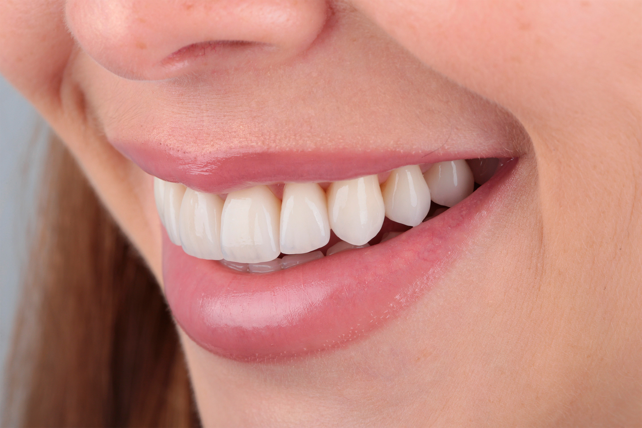 Установлены 13 керамических виниров и коронок.