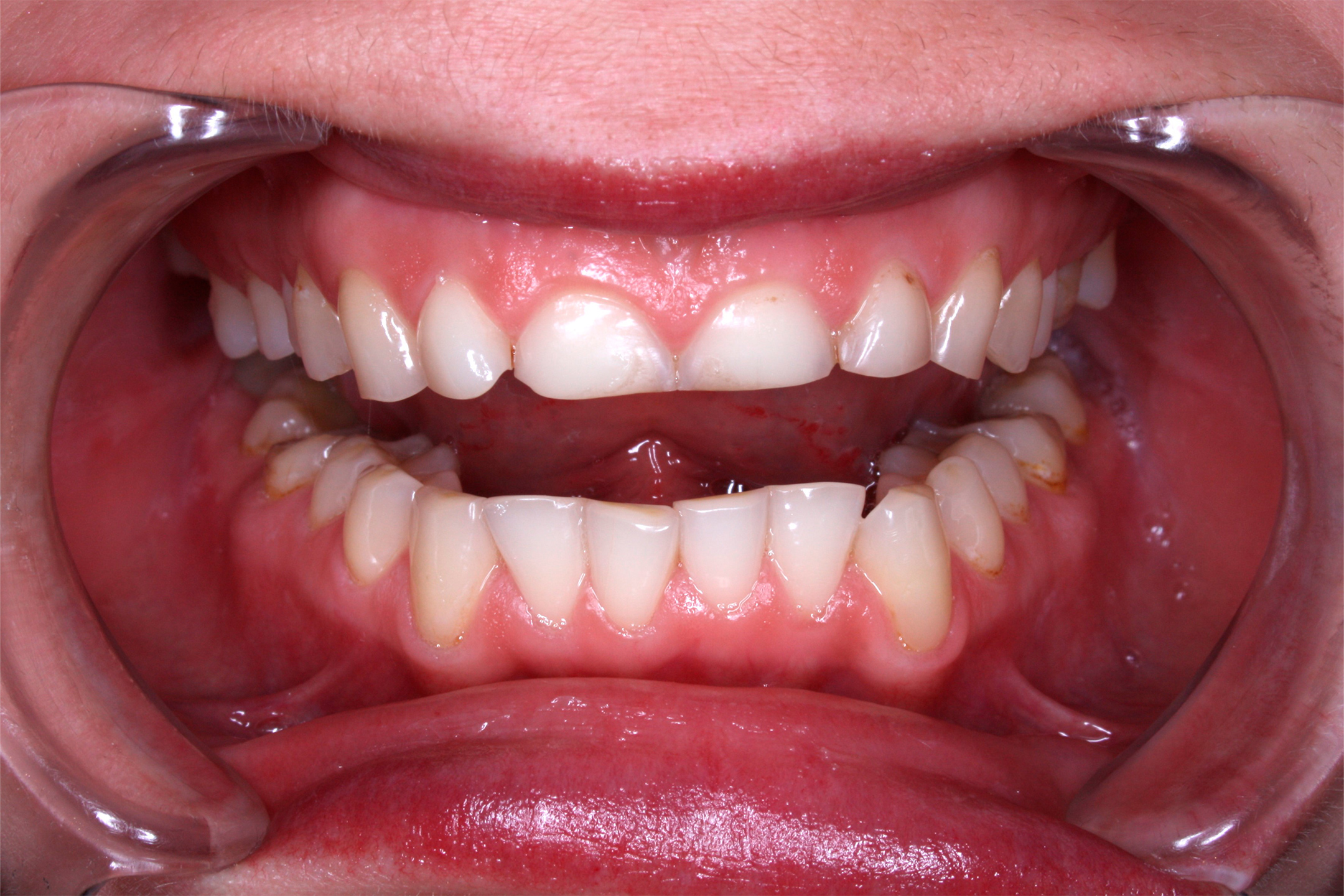 После примерки и утверждения макета будущей улыбки выполнена обработка зубов для установки виниров и коронок.