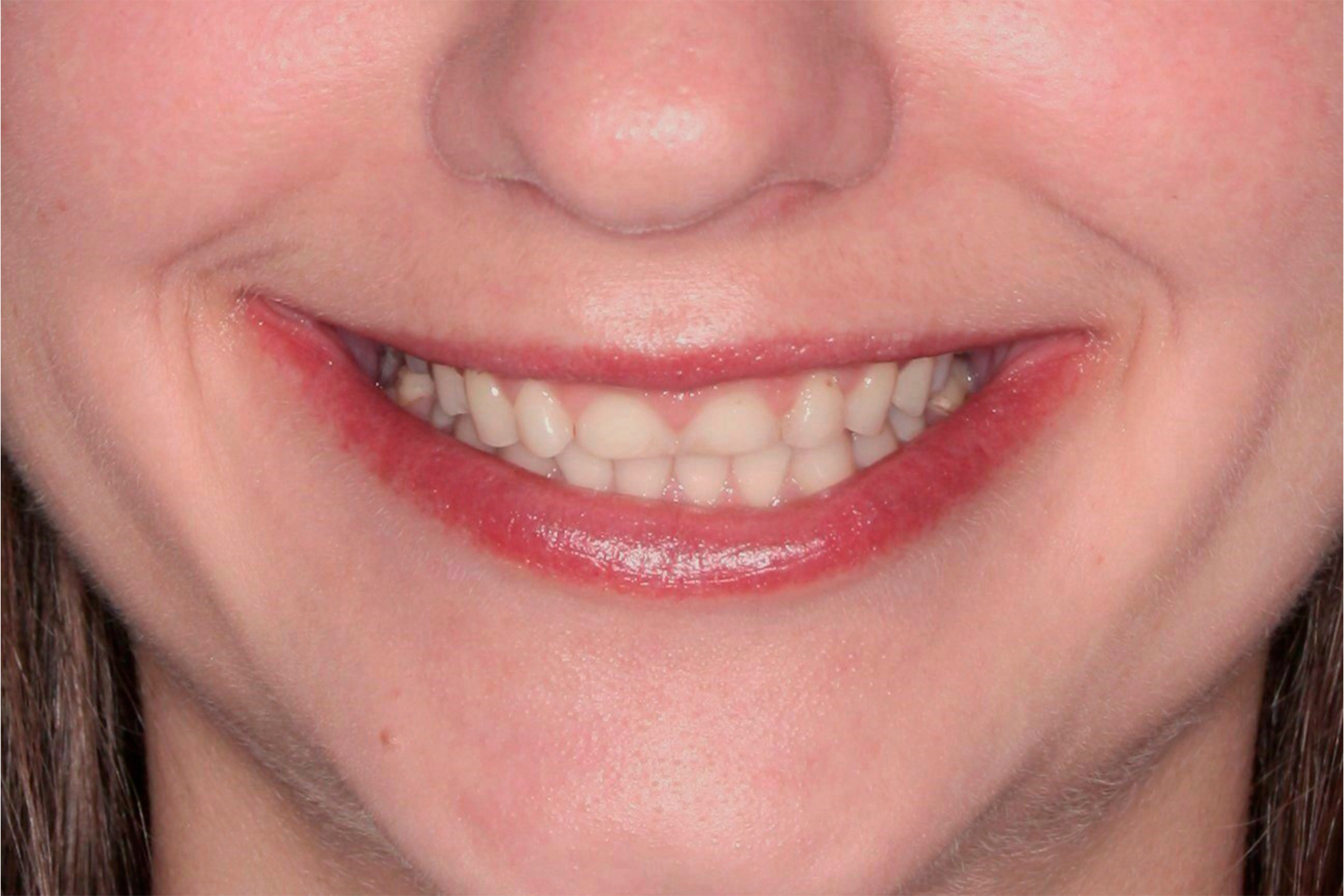 Мы предложили пациентке вернуть утерянную высоту прикуса, установить керамические виниры в зоне улыбки.