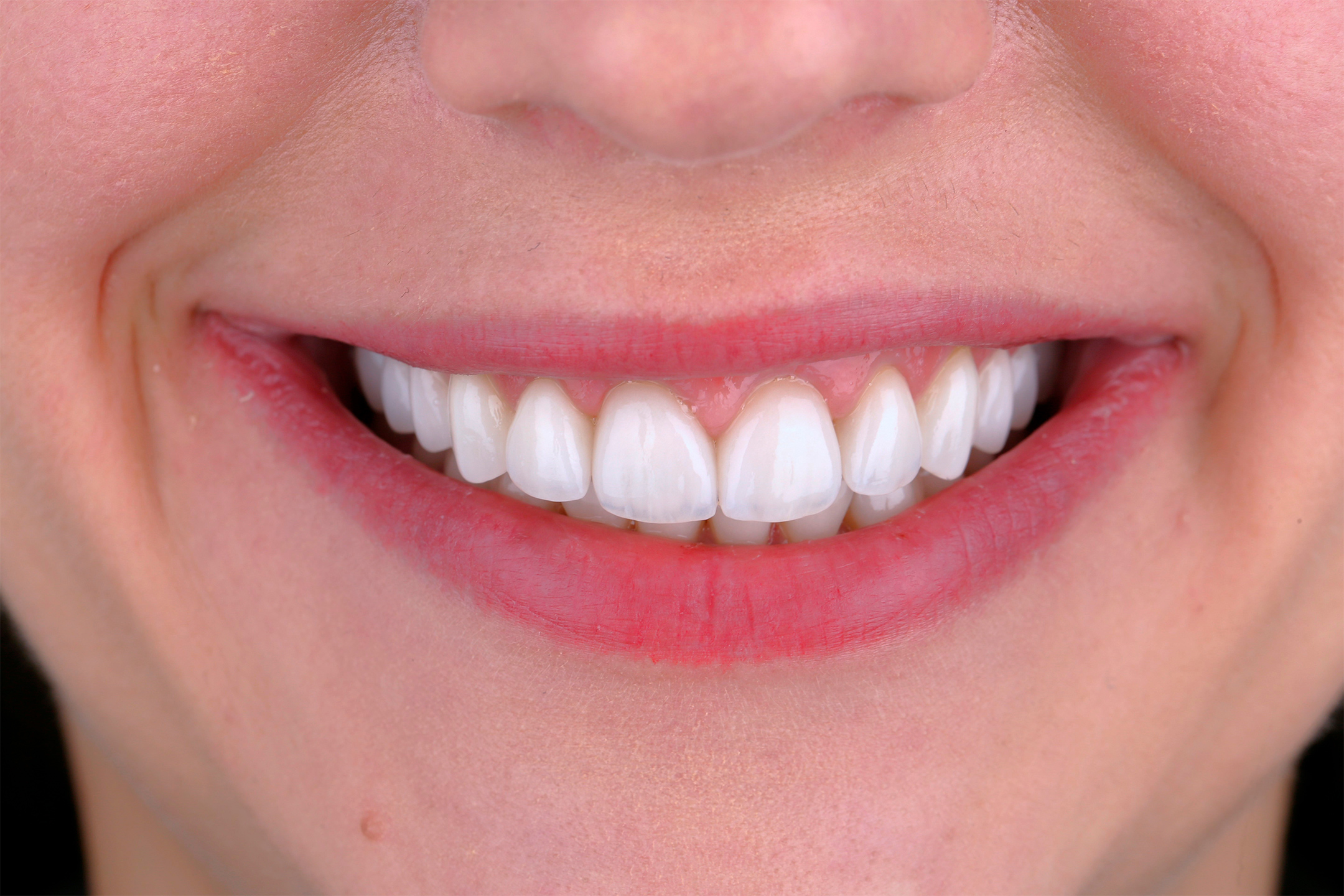 Минимальная подготовка зубов, Фиксация керамических виниров.