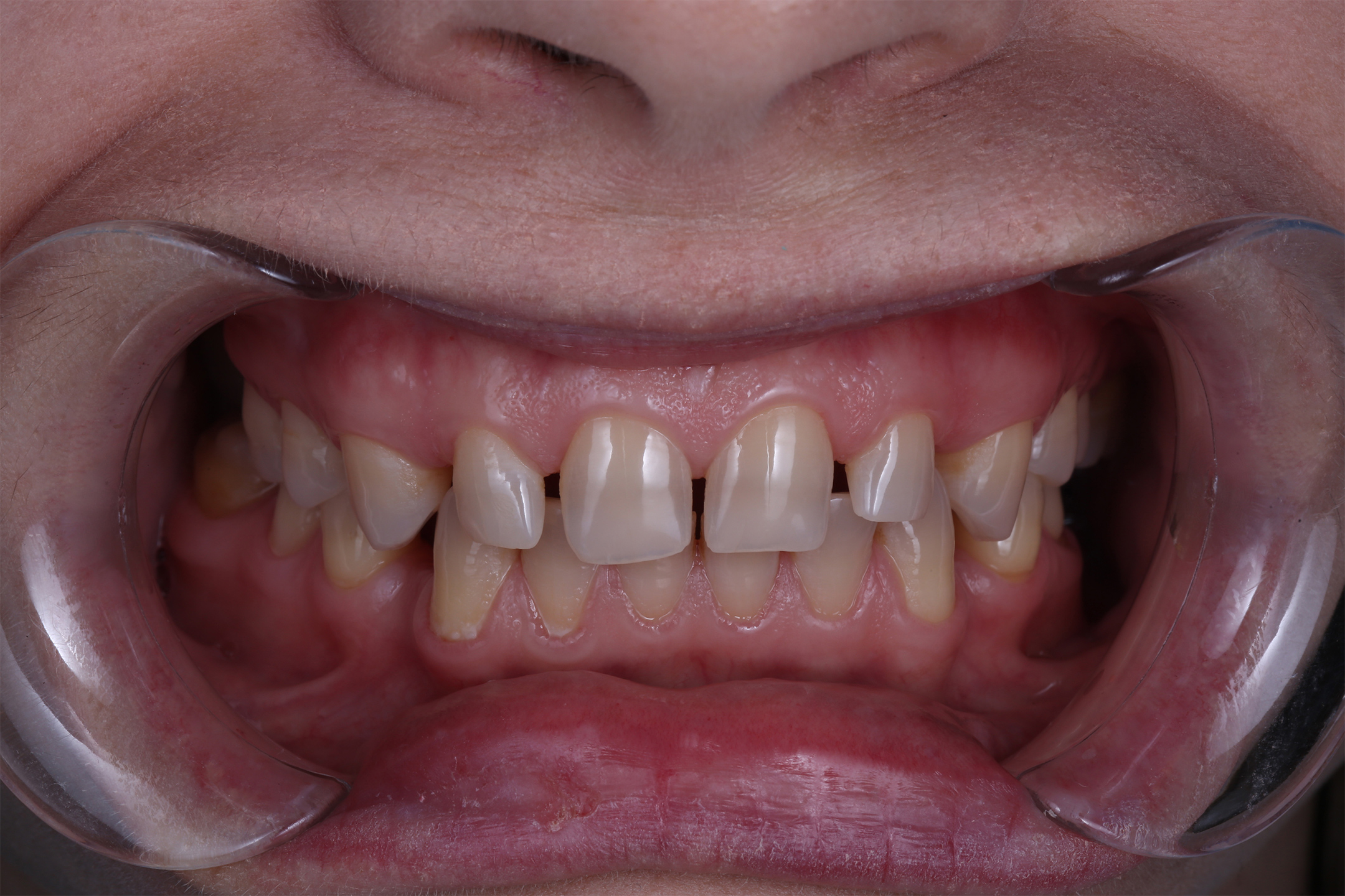 молодая девушка с патологической стираемостью зубов. Передние зубы потеряли треть своей длины из-за бруксизма.