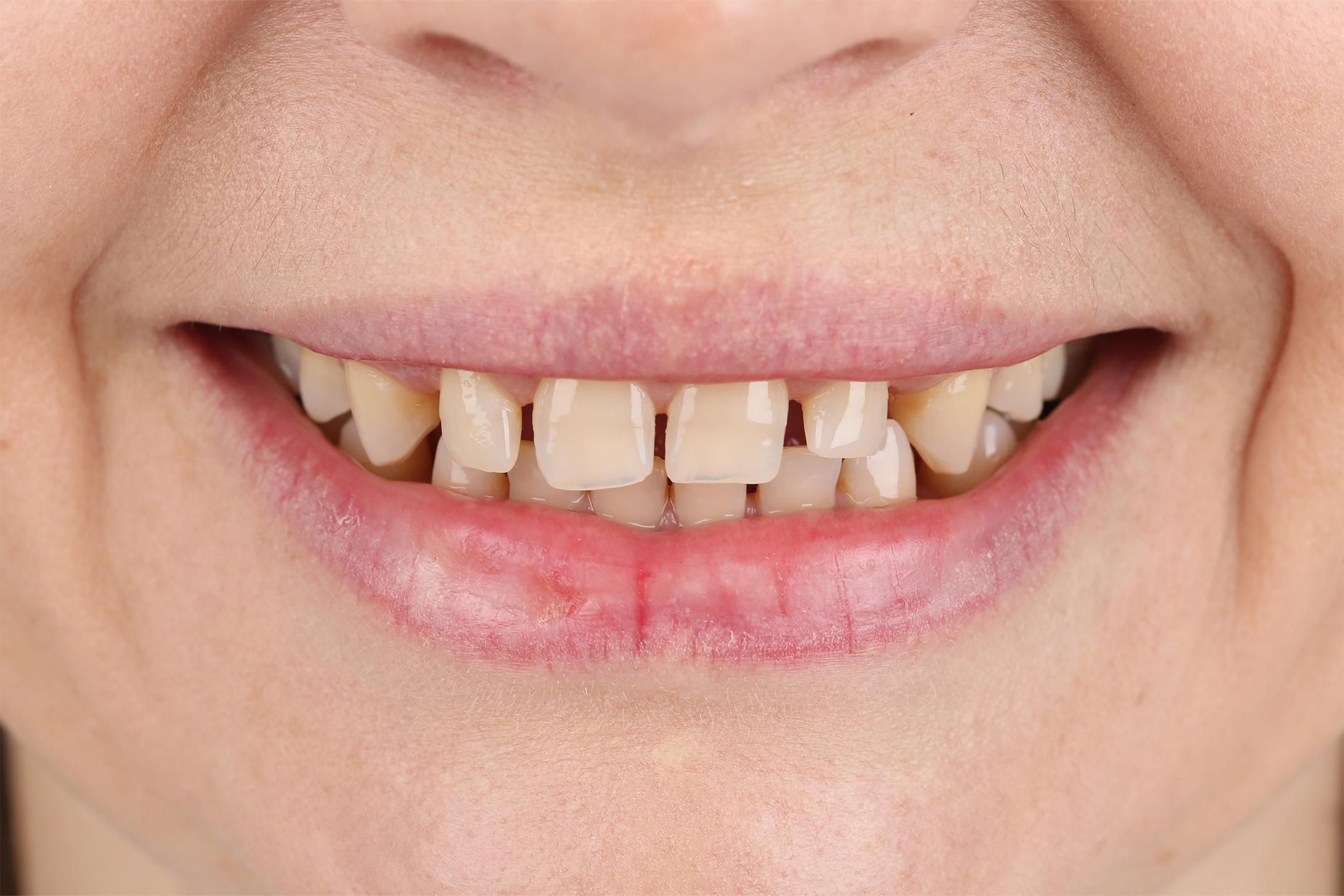 После осмотра и анализа снимка КТ мы предложили пациентке вернуть утерянную высоту прикуса.