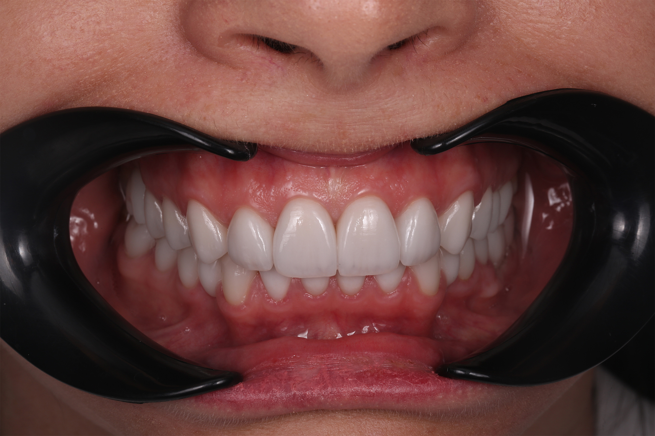 Пациентка обрела голливудскую улыбку мечты, стала увереннее в себе.