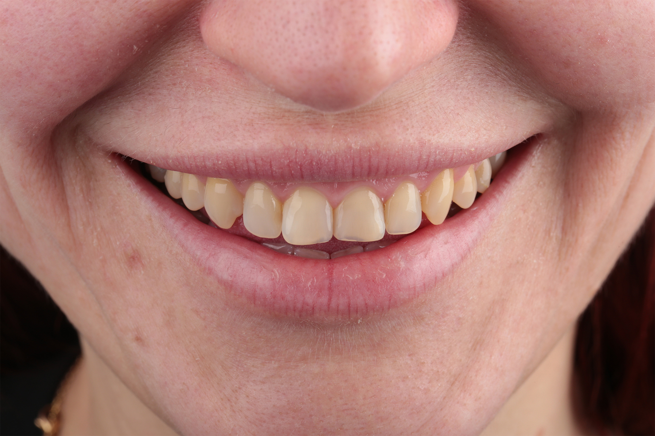 Удалены разрушенные зубы мудрости.