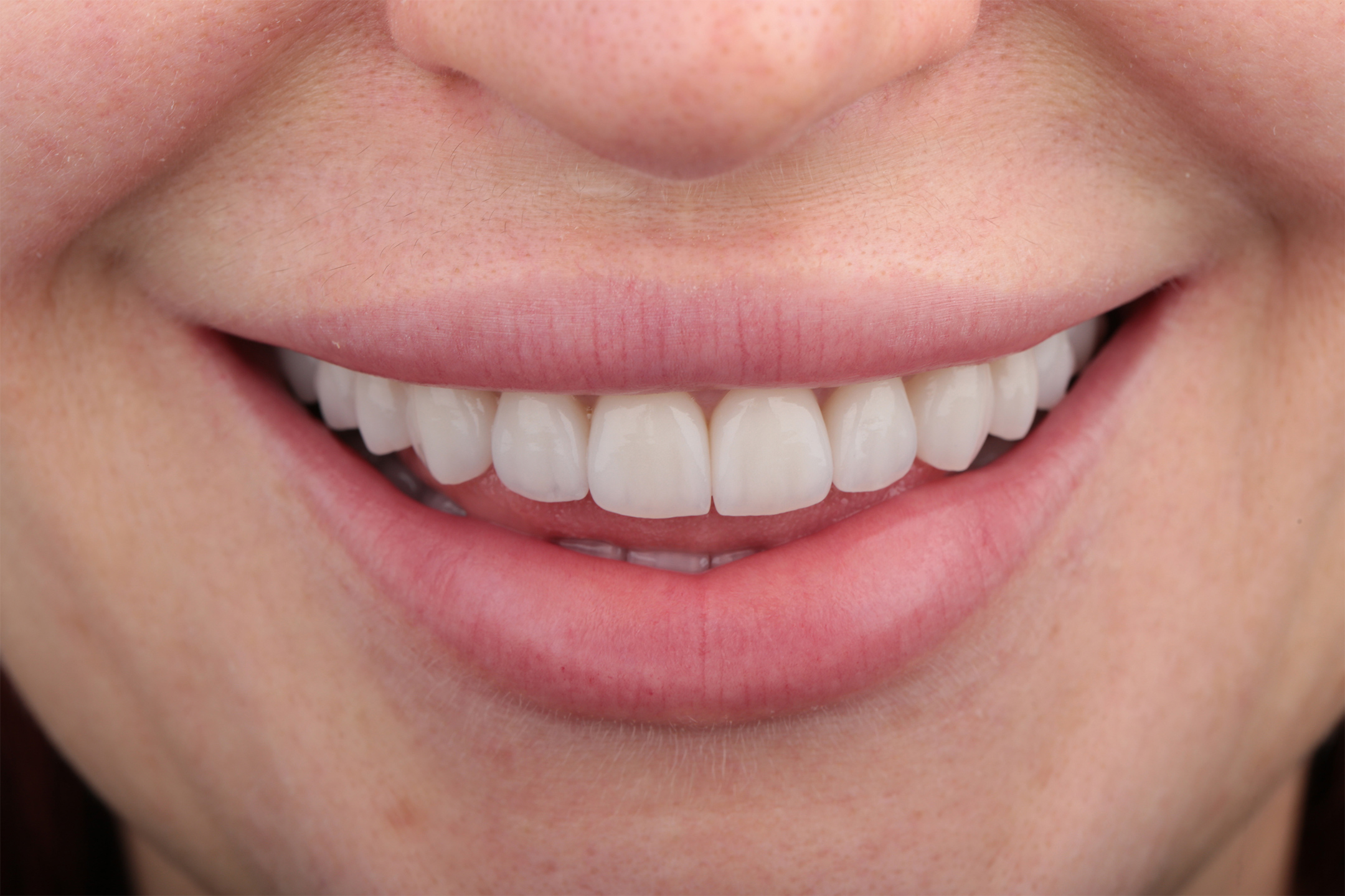 На время изготовления постоянной работы все зубы были покрыты временными пластмассовыми коронками.