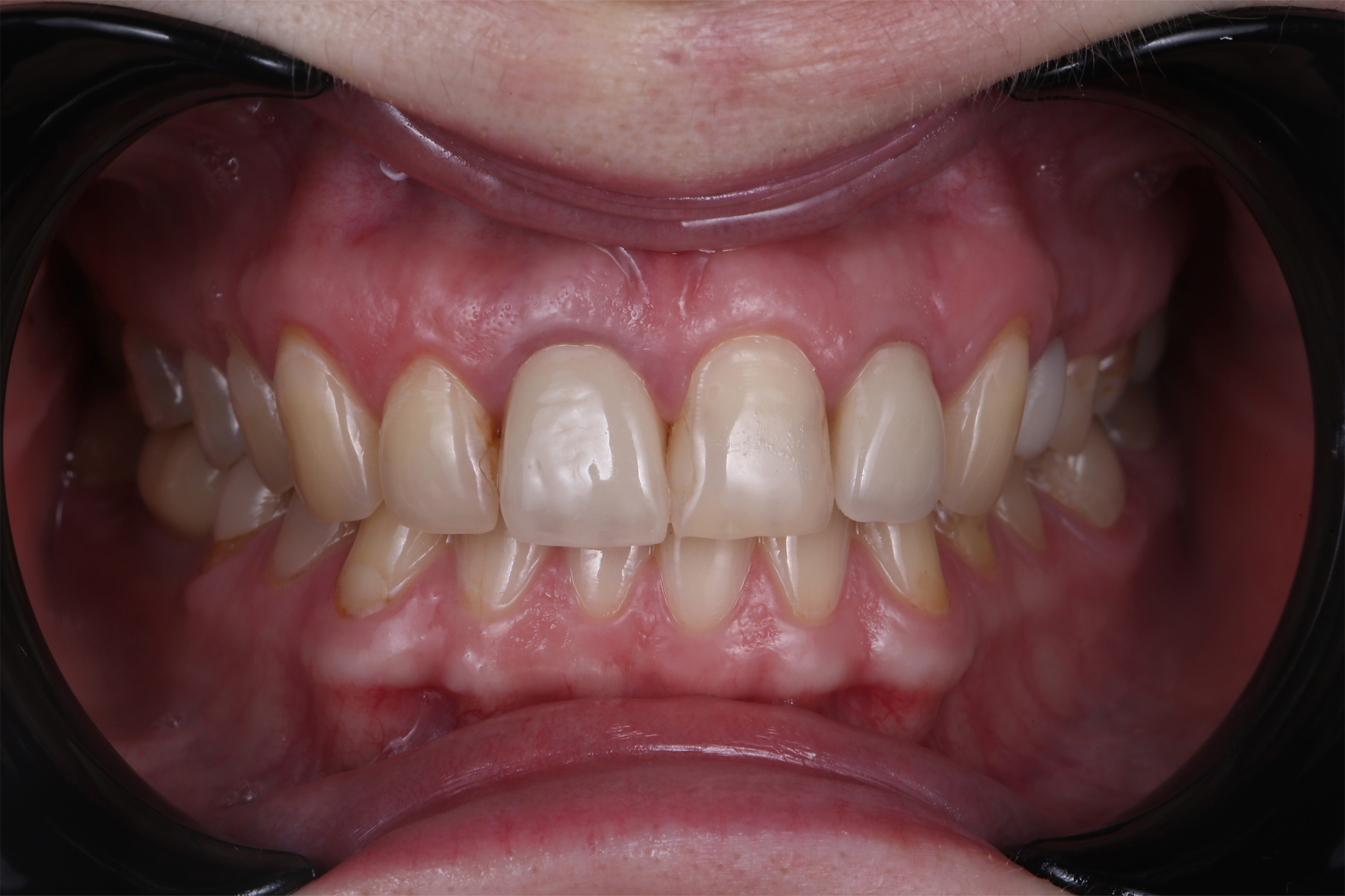 На передних зубах уже присутствовали виниры разных оттенков.