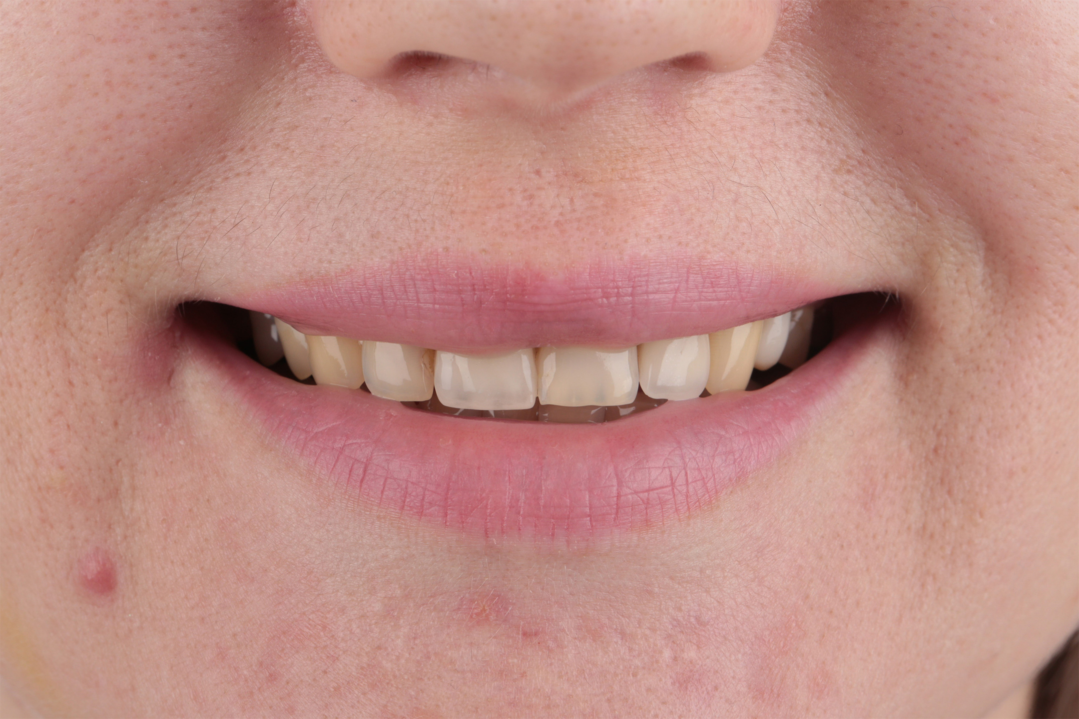 После осмотра и анализа снимка КТ пациентке составлен полноценный план лечения. Стоматолог терапевт провела полную санацию полости рта.