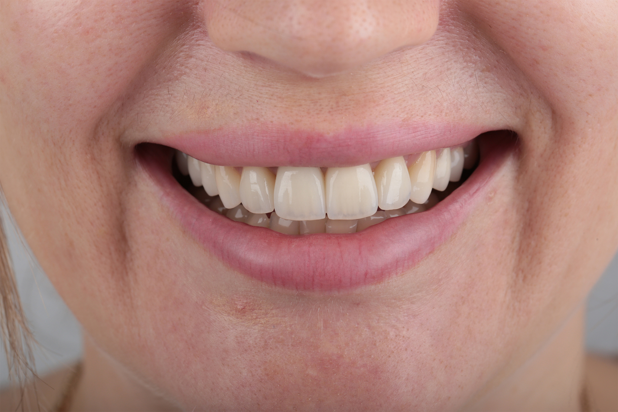 На время изготовления постоянной работы все зубы были покрыты временными пластмассовыми коронками.