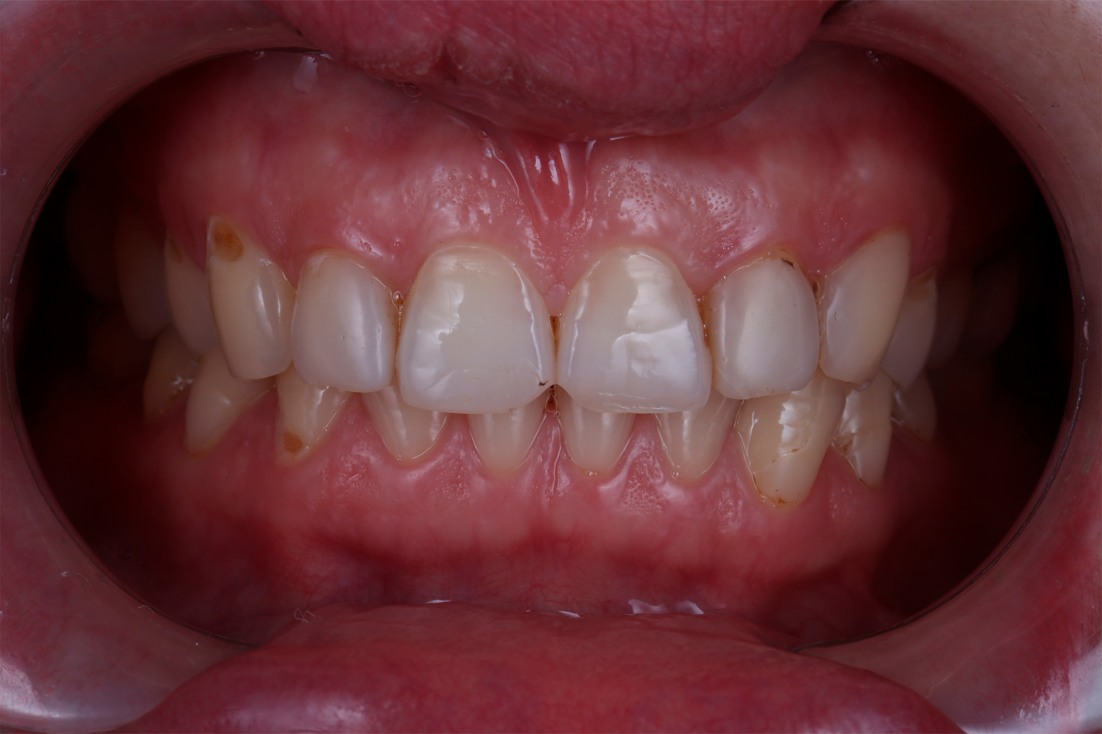 Нарушение косметического оптимума. Разрушение двух верхних жевательных зубов под установленными ранее металлокерамическими коронками.