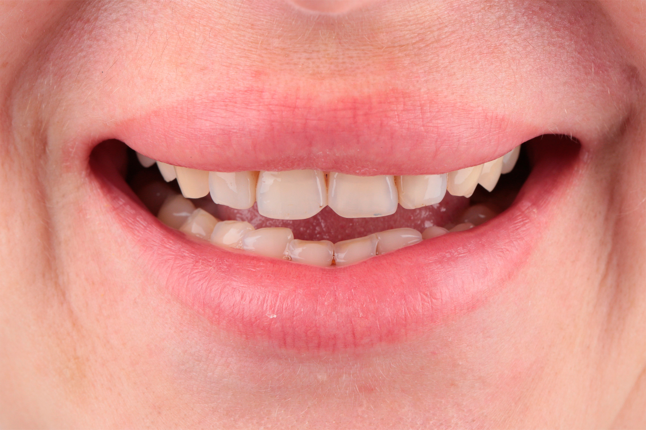 Проведено лечение кариозных зубов врачом терапевтом.