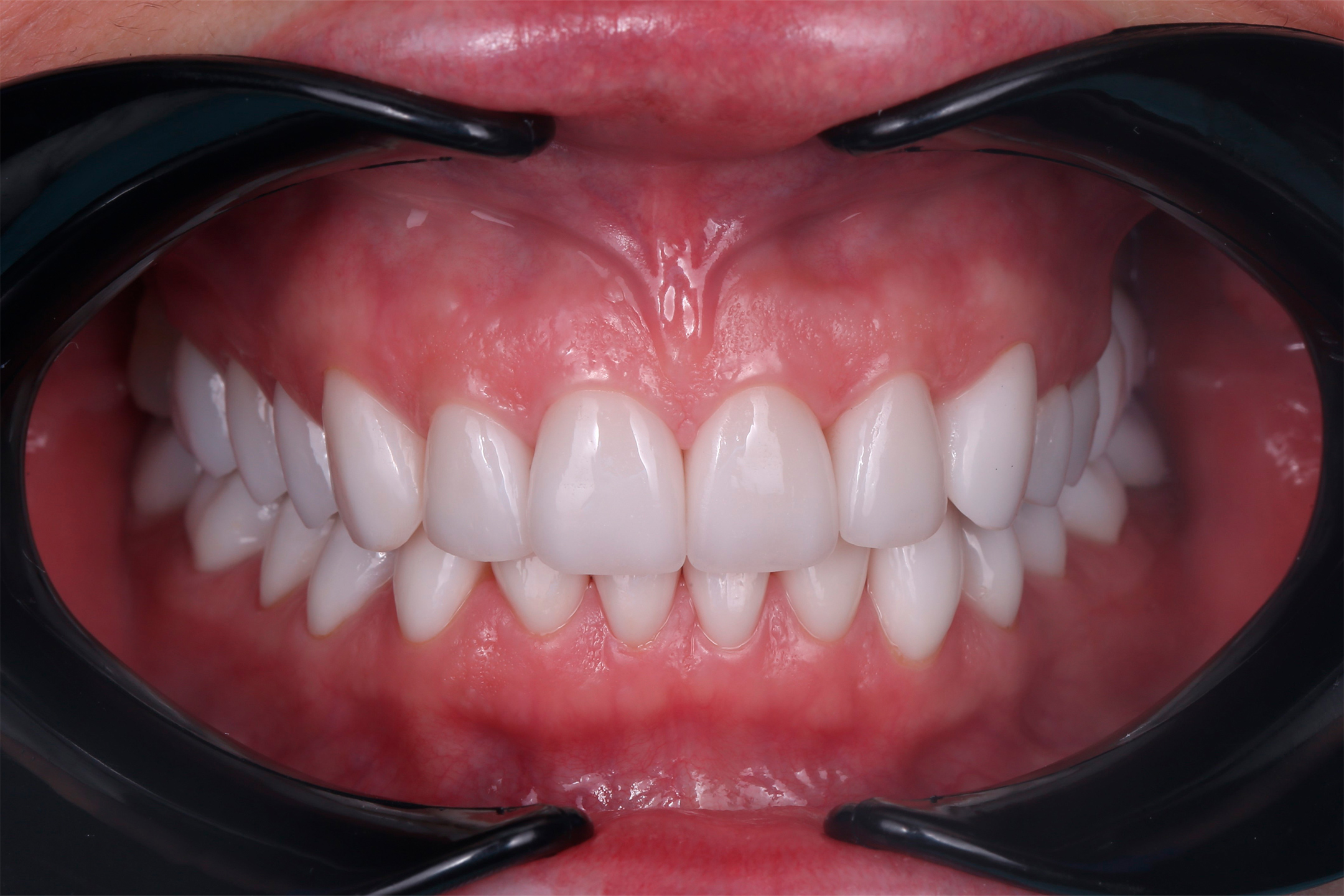 Лечение на винирах. Процесс лечения.